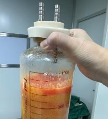莱州水动力吸脂手术要做多久？